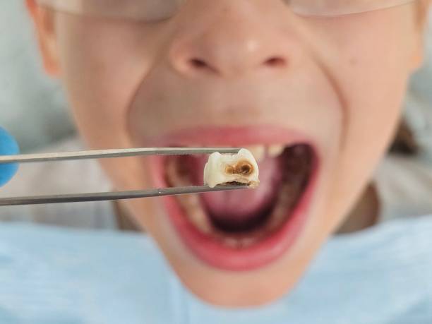 Urgent Tooth Repair in ID